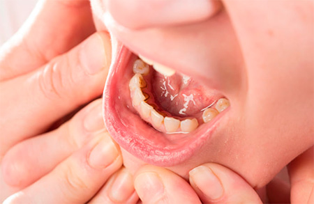 Los problemas dentales ¿afectan el lenguaje?